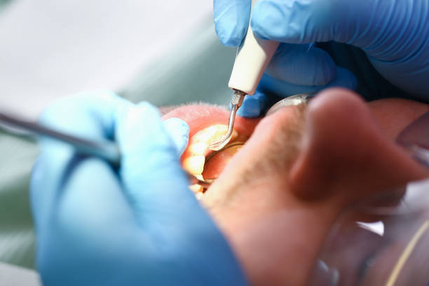 Best Emergency Tooth Extraction in Vaiden, MS